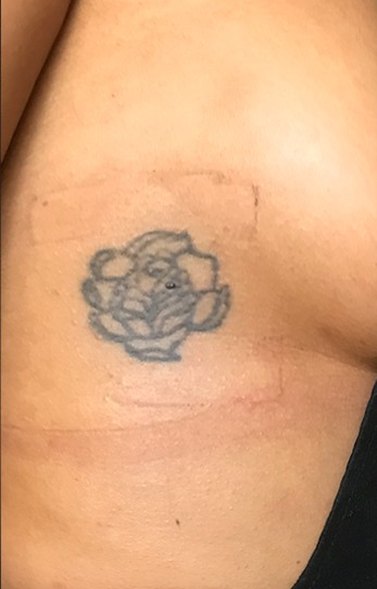 Tatuaje en eliminación láser en Ink Fire, Mazatlán, antes