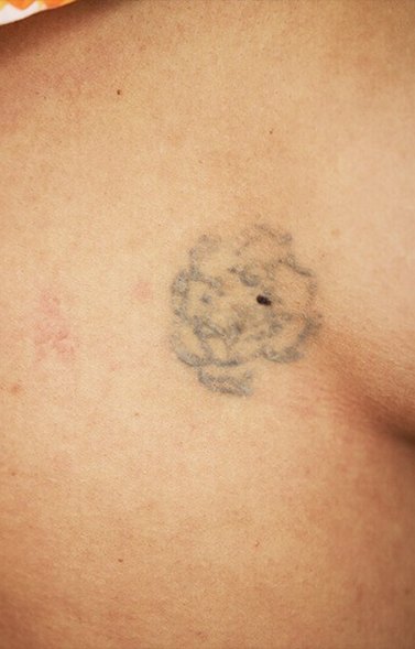 Tatuaje en eliminación láser en Ink Fire, Mazatlán, después de las sesiones