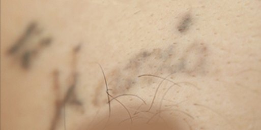 Tatuaje en eliminación láser en Ink Fire, Mazatlán, después de las sesiones