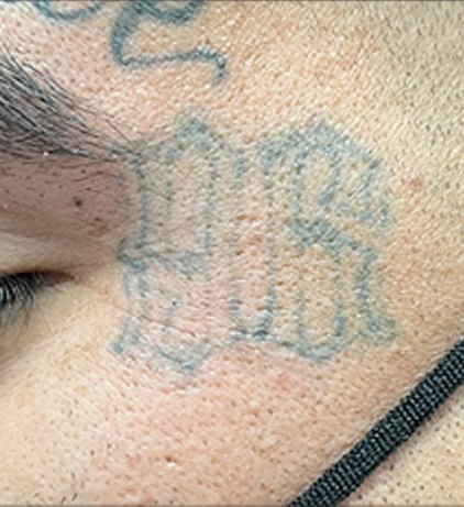 Tatuaje en eliminación láser en Ink Fire, Mazatlán, después de las sesiones