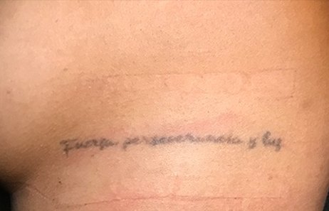 Tatuaje en eliminación láser en Ink Fire, Mazatlán, antes
