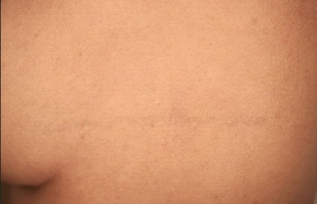 Tatuaje en eliminación láser en Ink Fire, Mazatlán, después de las sesiones