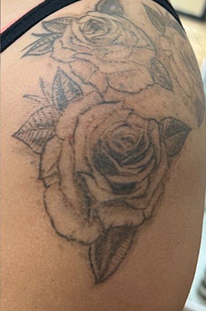 Tatuaje en eliminación láser en Ink Fire, Mazatlán, después de las sesiones