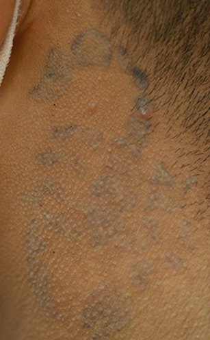 Tatuaje en eliminación láser en Ink Fire, Mazatlán, después de las sesiones