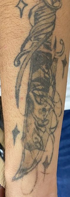 Tatuaje en eliminación láser en Ink Fire, Mazatlán, después de las sesiones
