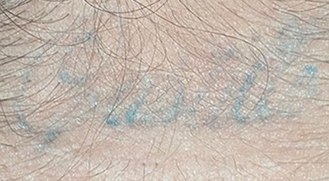 Tatuaje en eliminación láser en Ink Fire, Mazatlán, después de las sesiones